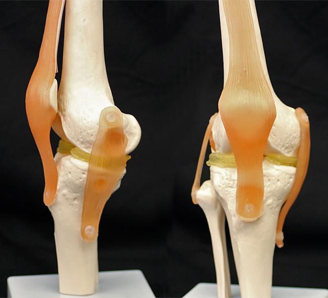 3D Printed Knee Implants