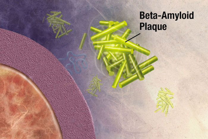 Beta Amyloid Plague
