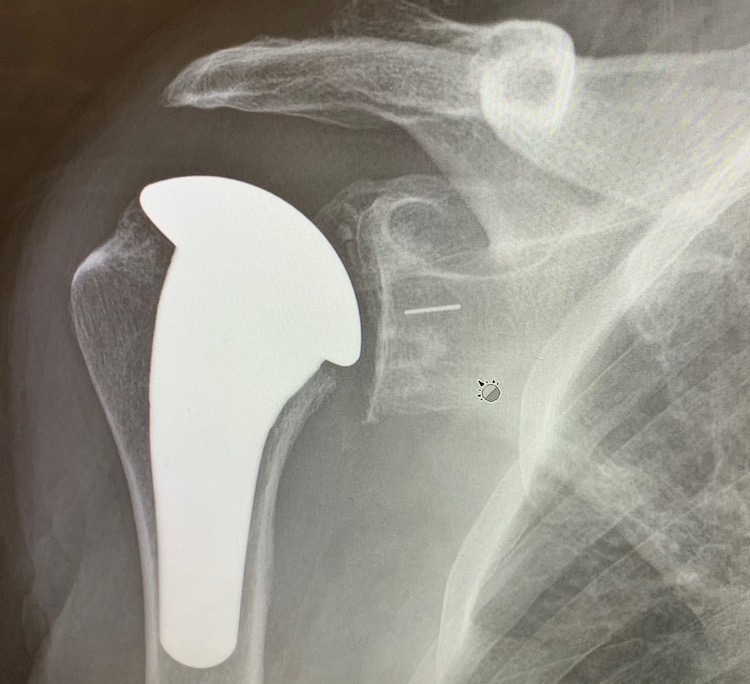 Right Shoulder Prosthesis